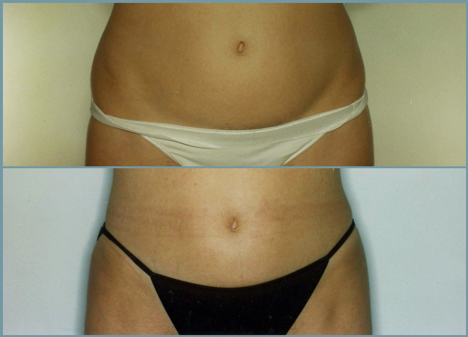 Abdominal Wall Liposuction Sculpture Female