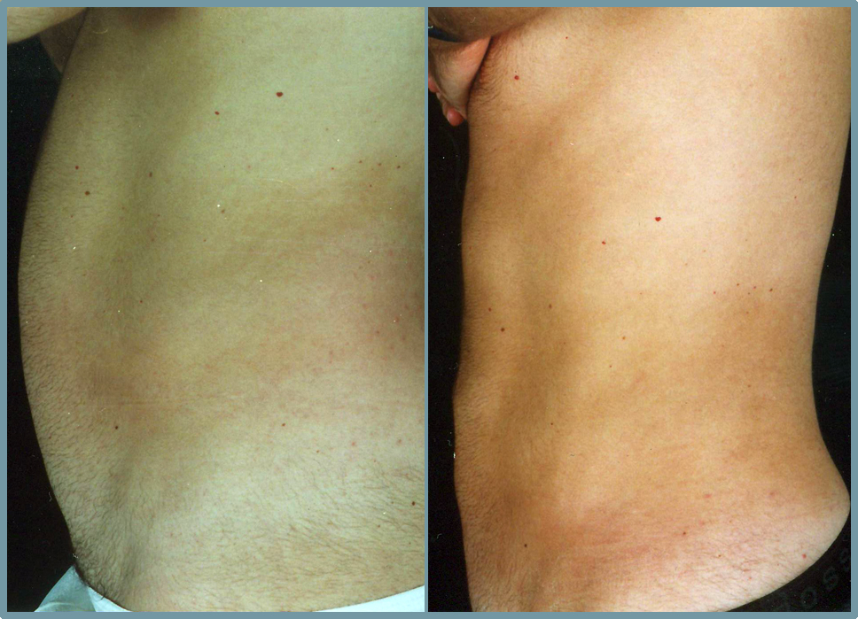 Abdominal Wall Liposuction Sculpture Male