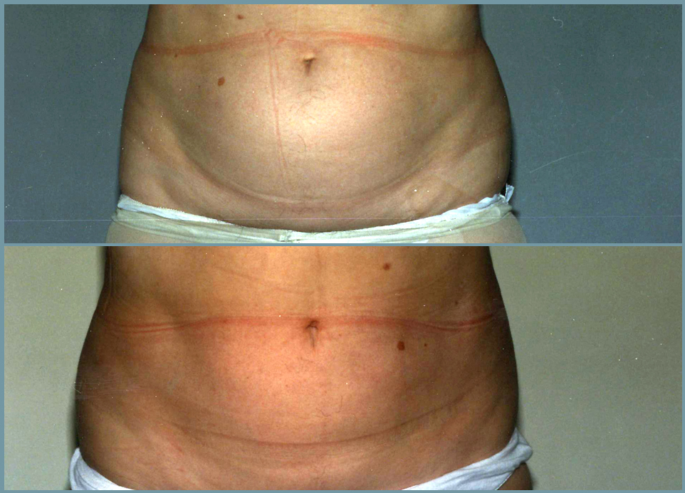 Liposculpturing