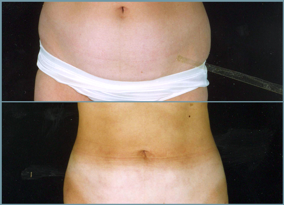 Liposculpturing