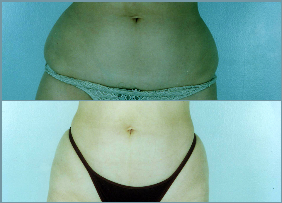 Liposculpturing