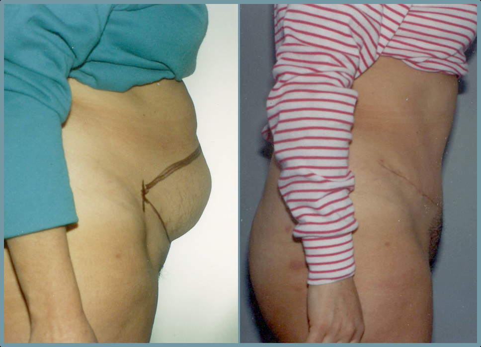 Abdomen - Abdominoplasty