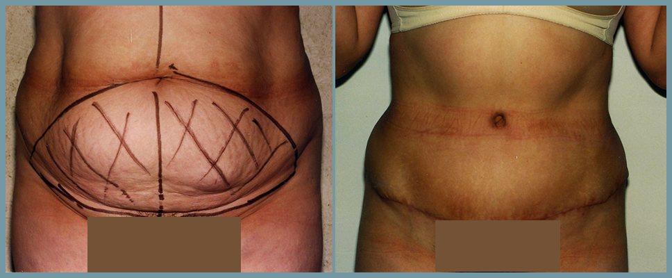 Abdomen - Abdominoplasty