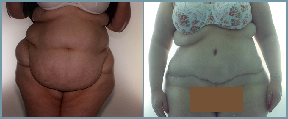 Abdomen - Abdominoplasty