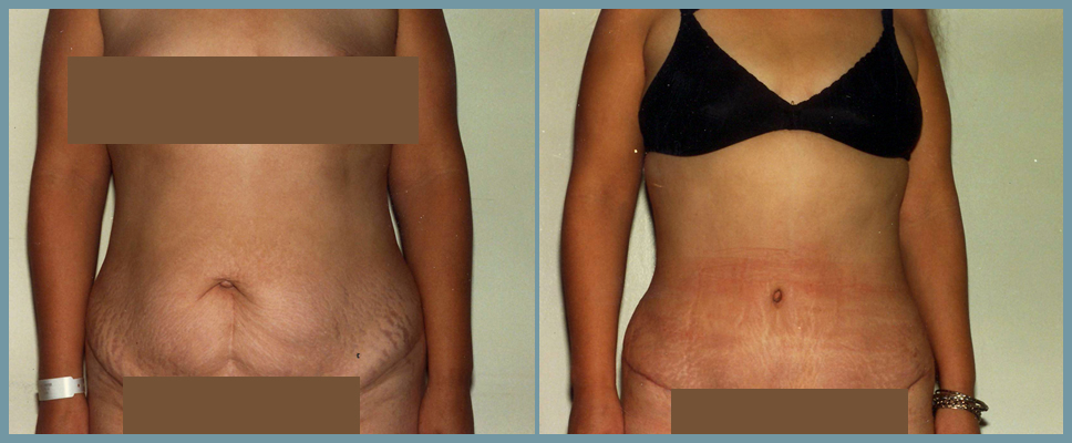 Abdomen - Abdominoplasty