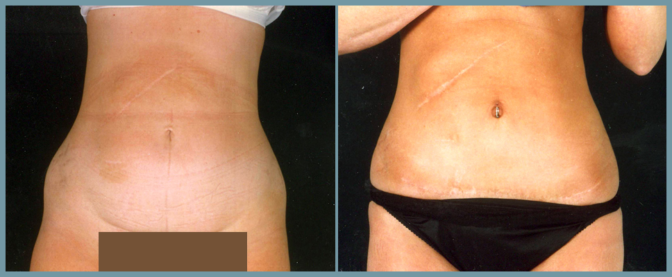 Abdomen - Abdominoplasty