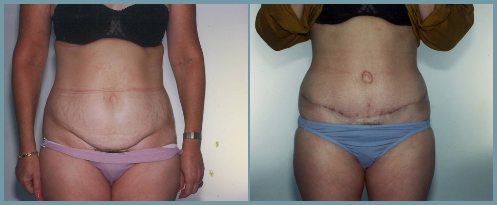 Abdomen - Abdominoplasty
