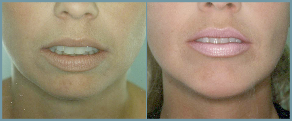 Chin Agumentation