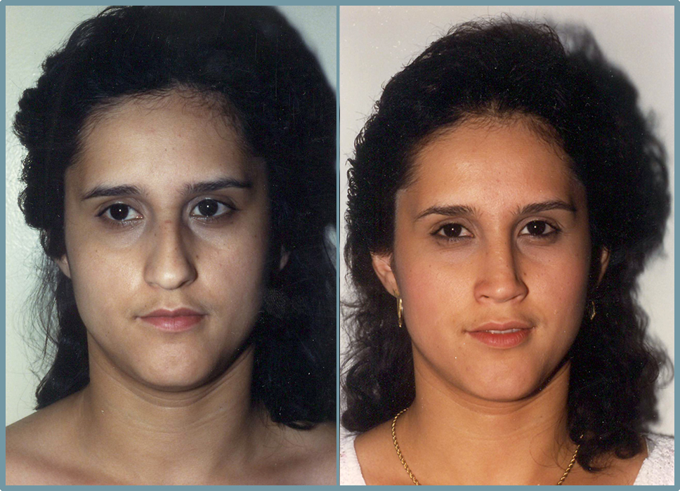 Nose Surgery - Rhinoplasty Women