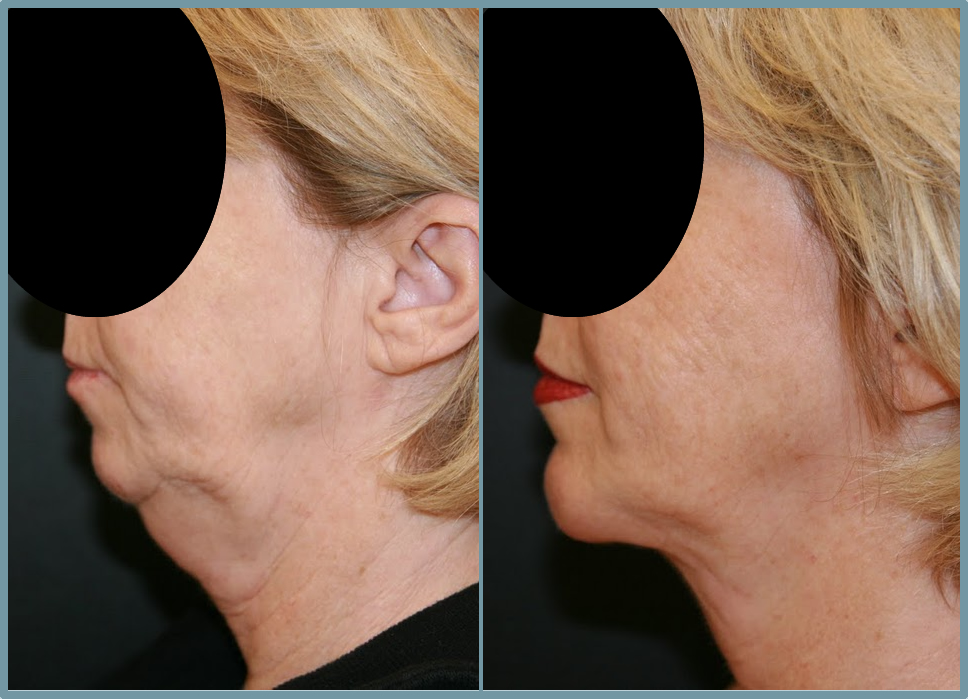 Chin Agumentation