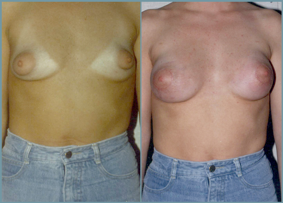 Congenital Breast Deformity