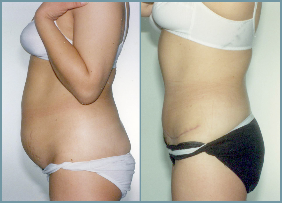 Abdomen - Abdominoplasty