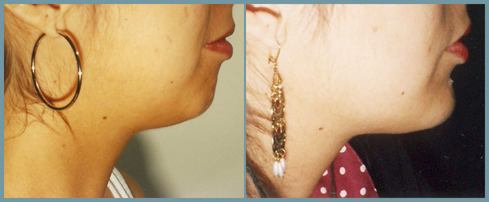 Chin Agumentation
