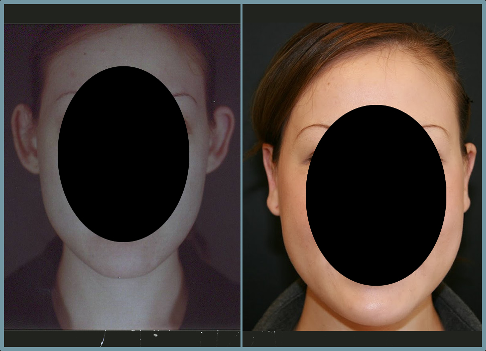 Otoplasty