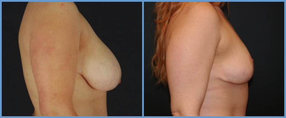 Congenital Breast Deformity