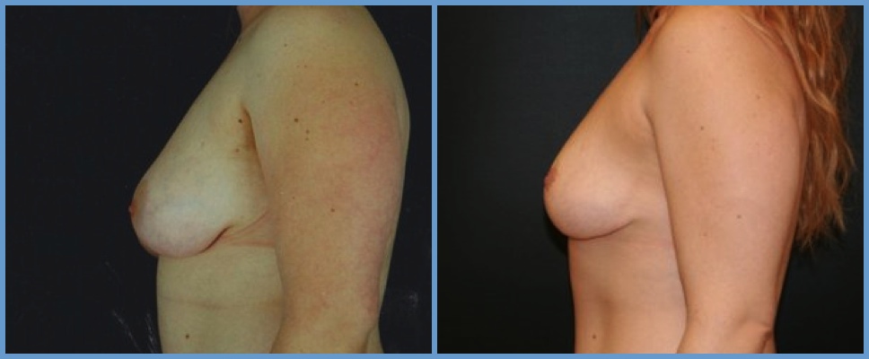Congenital Breast Deformity