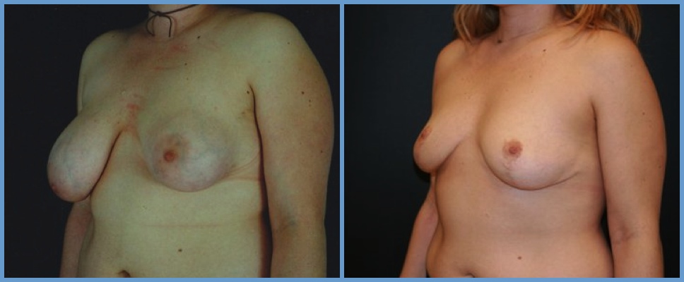 Congenital Breast Deformity