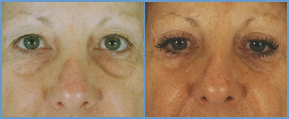 Eyelid Surgery - Blepharoplasty