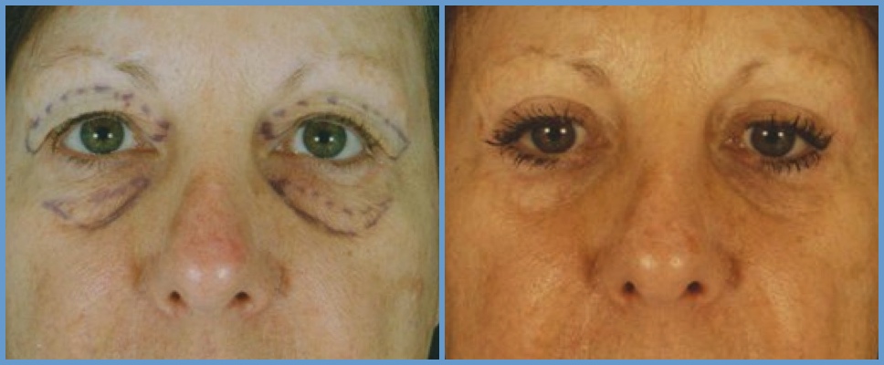 Eyelid Surgery - Blepharoplasty