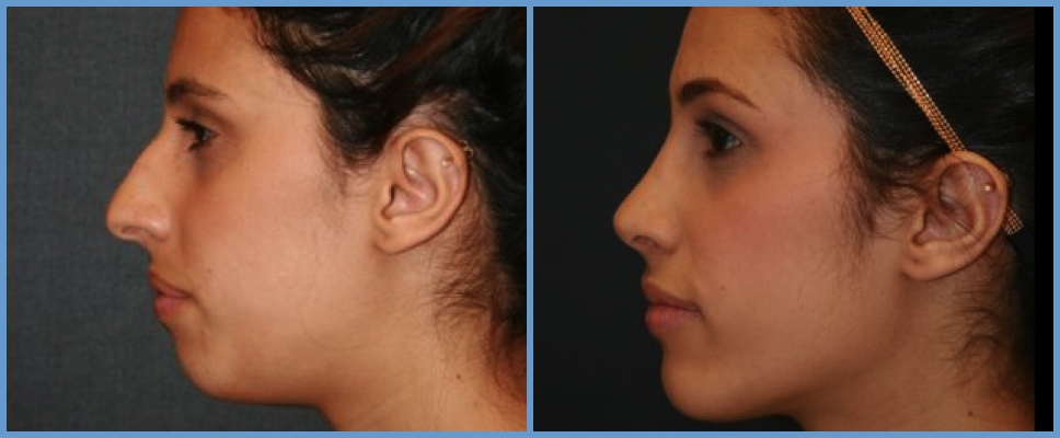 Nose Surgery - Rhinoplasty Women