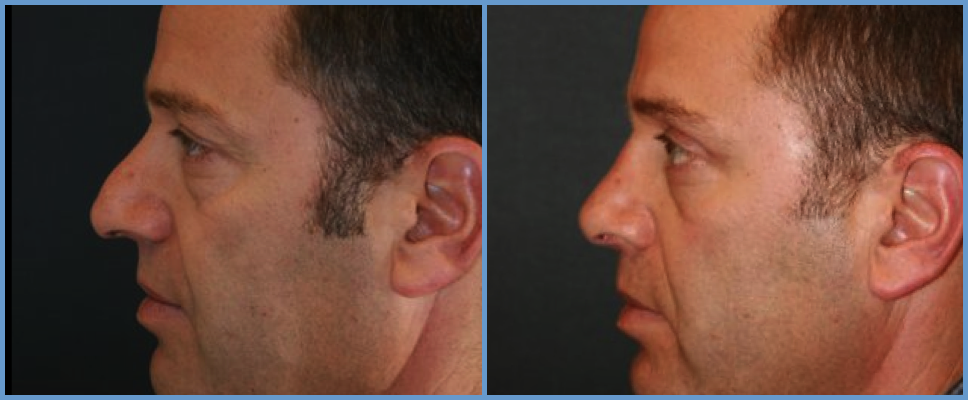 Nose Surgery - Rhinoplasty Men