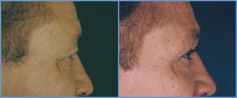 Brow Lift or Forehead Lift