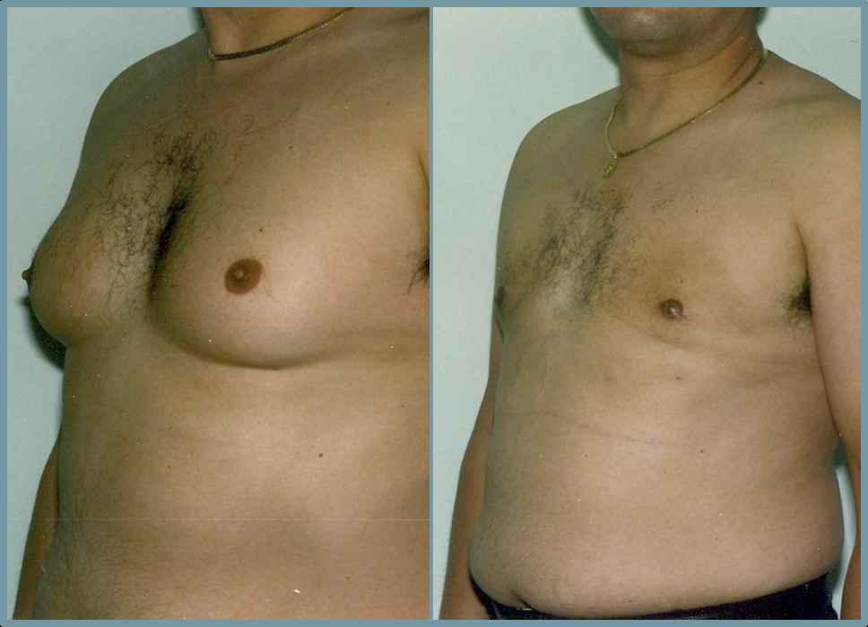 Breast Reduction - Gynecomastia