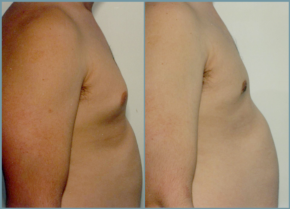 Breast Reduction - Gynecomastia