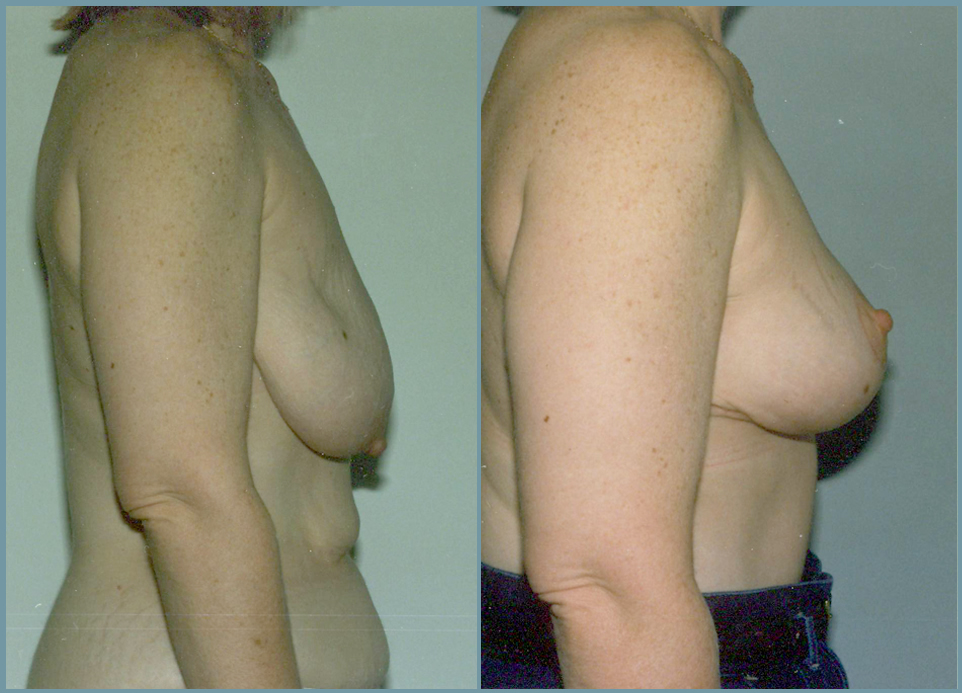 Breast Lift - Mastoplexy