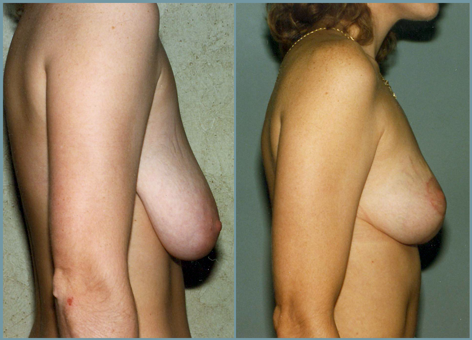 Breast Lift - Mastoplexy