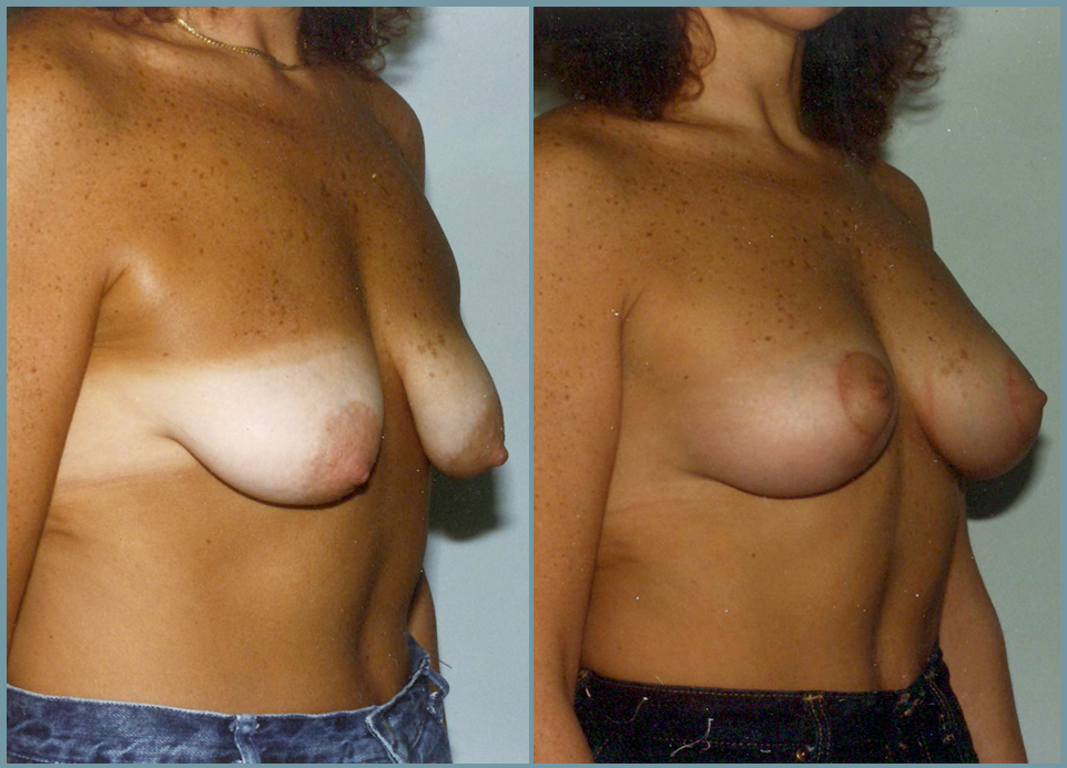 Breast Lift - Mastoplexy