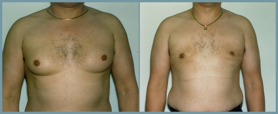 Breast Reduction - Gynecomastia