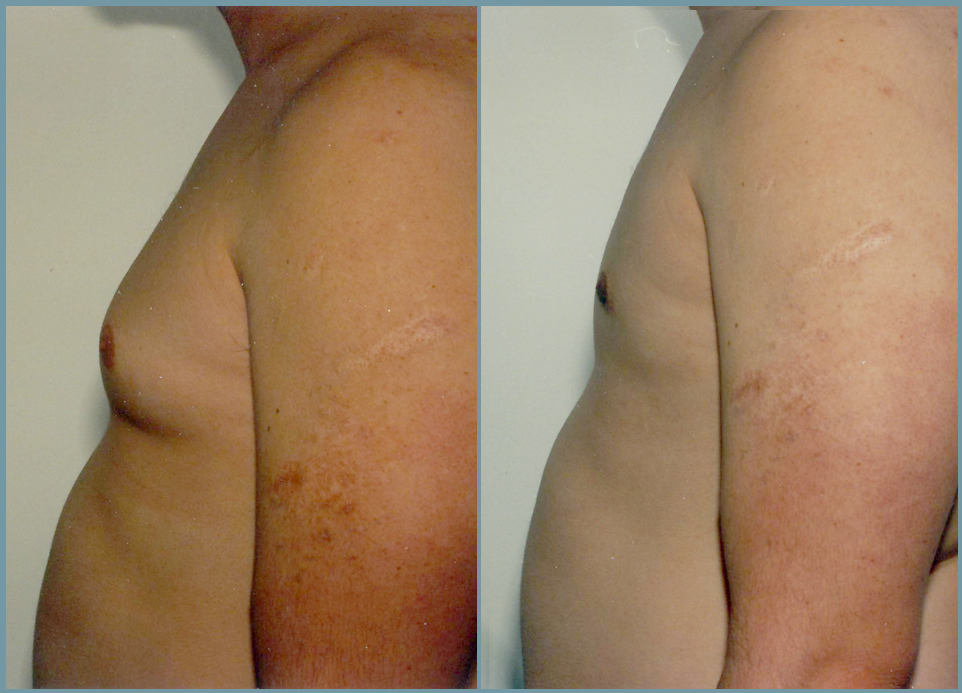 Breast Reduction - Gynecomastia