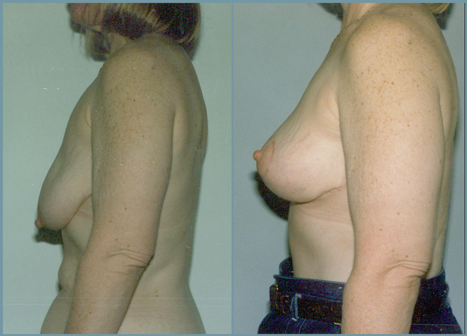 Breast Lift - Mastoplexy