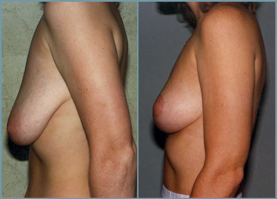 Breast Lift - Mastoplexy