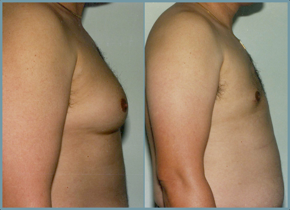 Breast Reduction - Gynecomastia