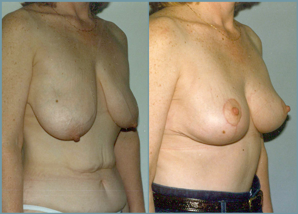 Breast Lift - Mastoplexy