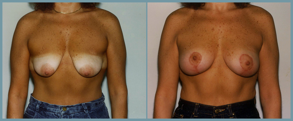 Breast Lift - Mastoplexy