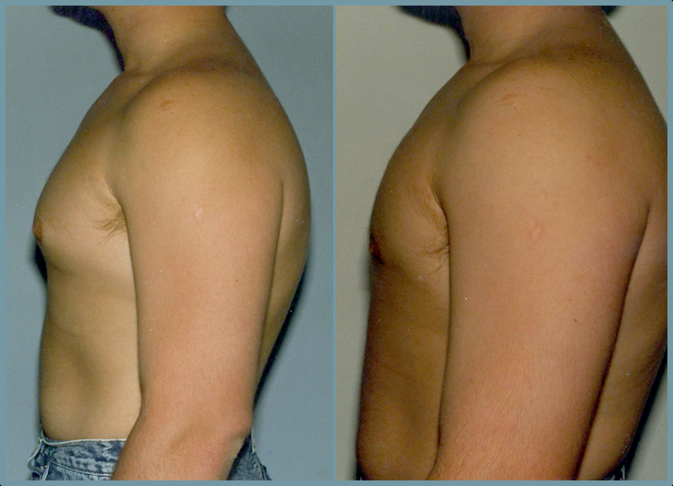 Breast Reduction - Gynecomastia
