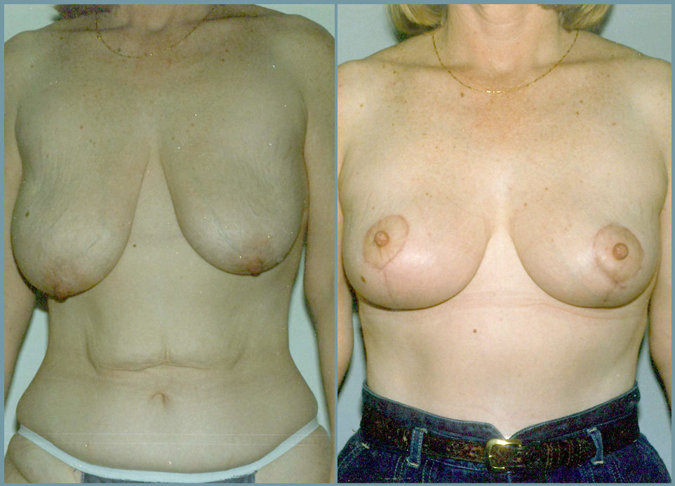 Breast Lift - Mastoplexy