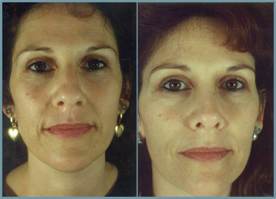 Facial
