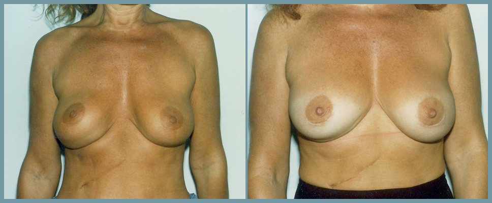 Breast Reconstruction