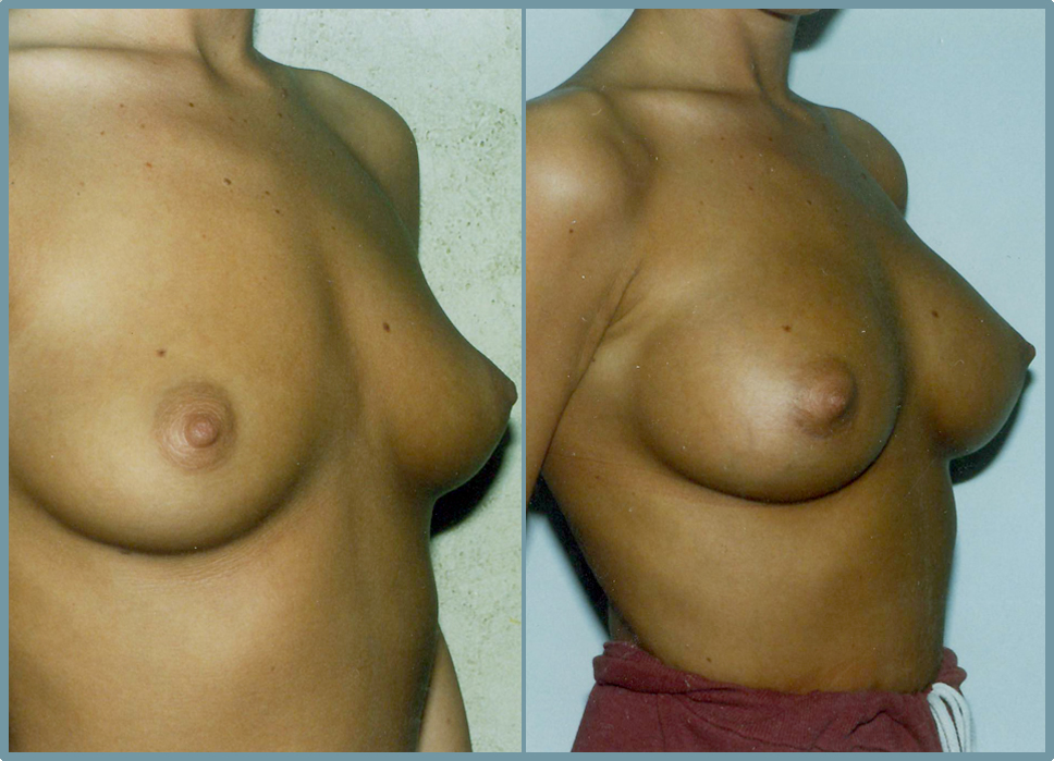 Breast Enlargement – Breast Enhancement