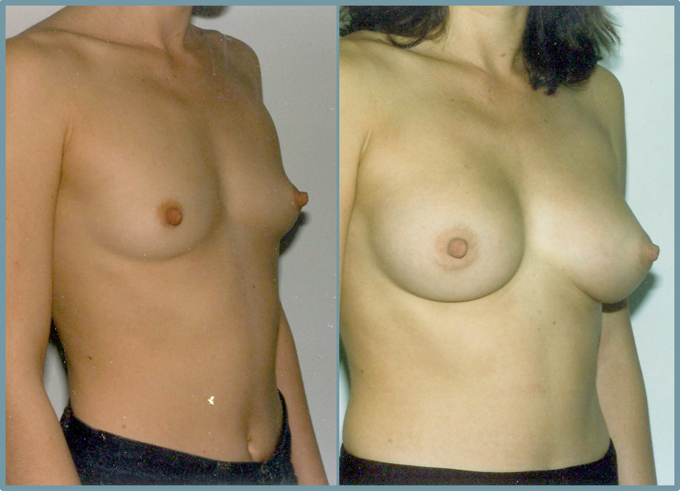 Breast Enlargement  Breast Enhancement