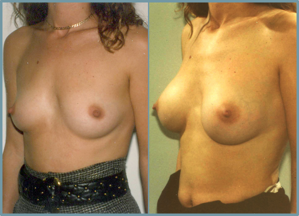 Breast Enlargement  Breast Enhancement