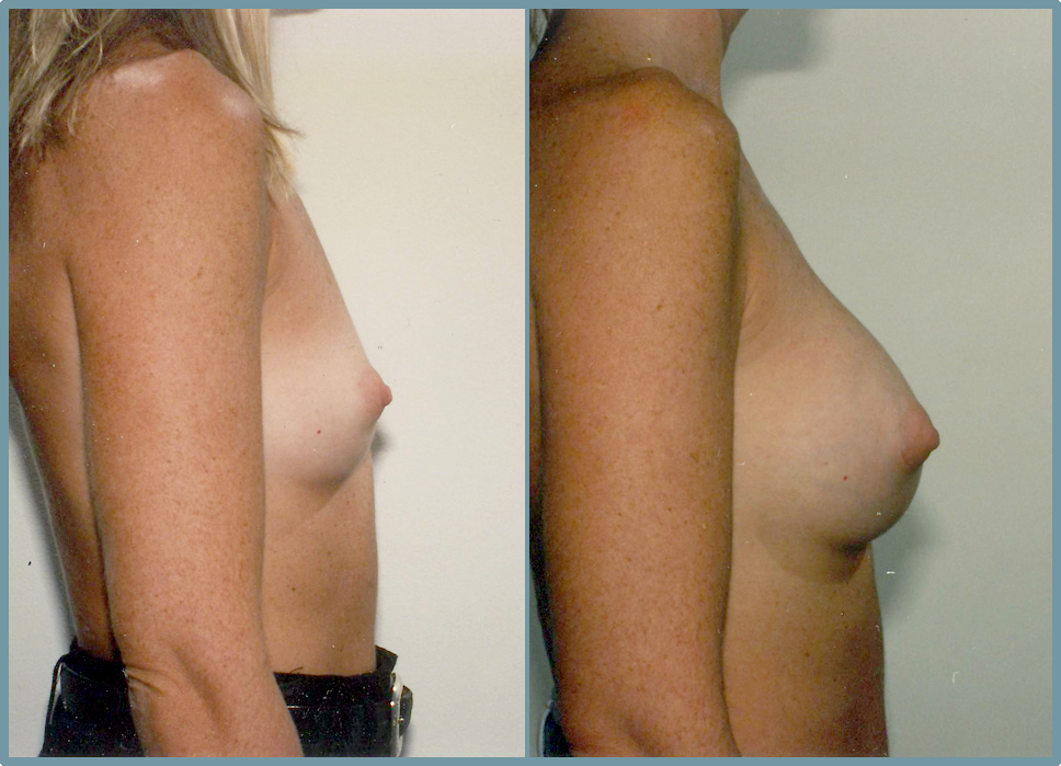 Breast Enlargement  Breast Enhancement