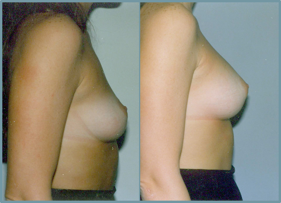 Breast Enlargement  Breast Enhancement
