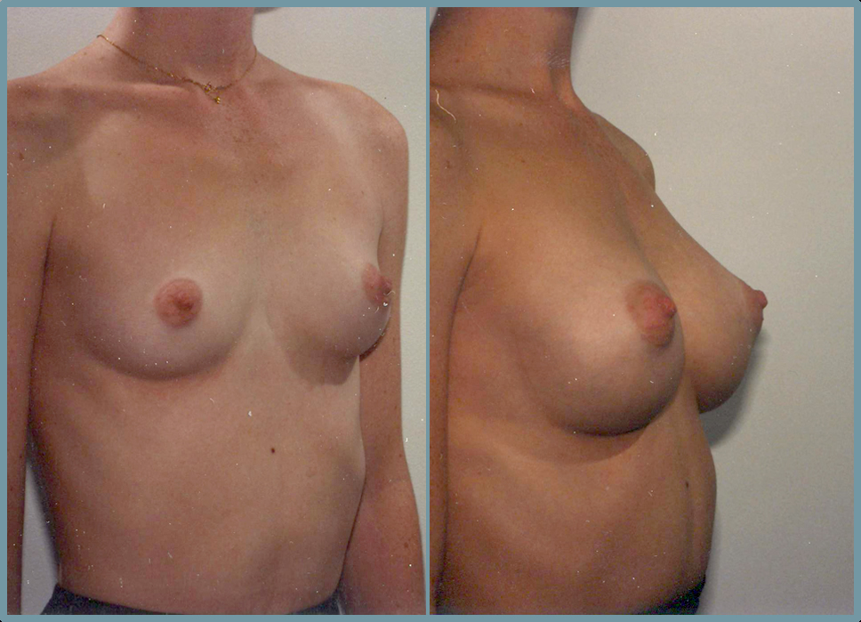 Breast Enlargement  Breast Enhancement