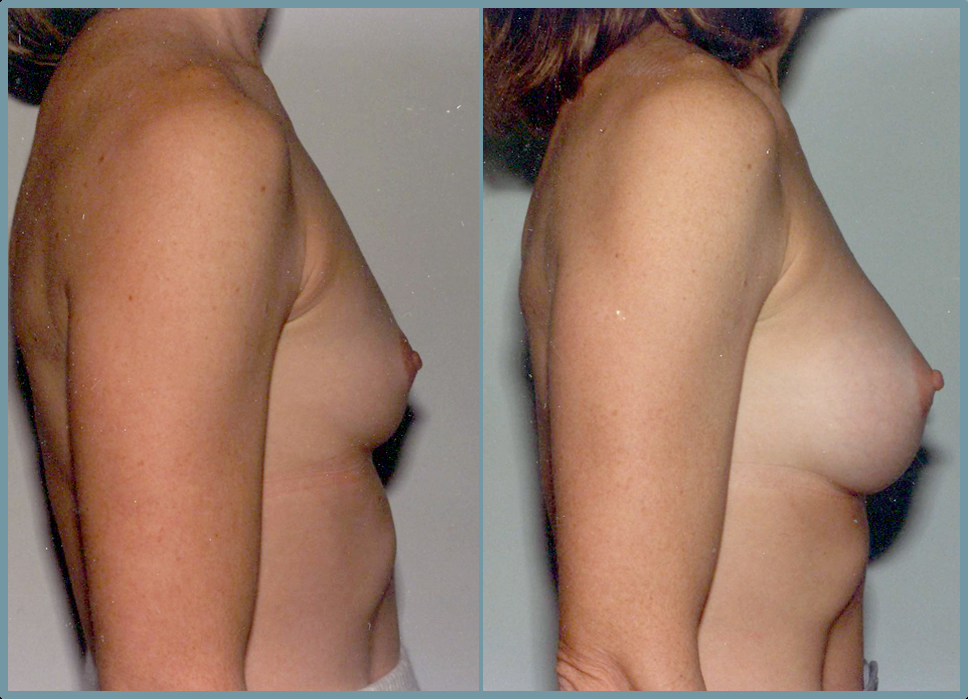 Breast Enlargement  Breast Enhancement