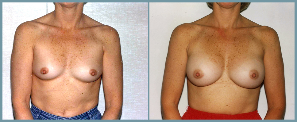 Breast Enlargement  Breast Enhancement